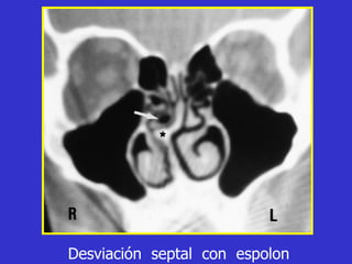 Desviación  septal  con  espolon 