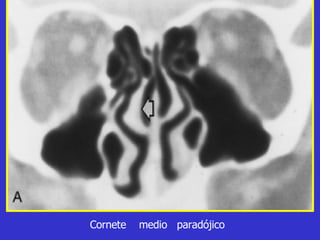 Cornete  medio  paradójico 