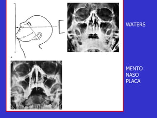 WATERS MENTO NASO PLACA 