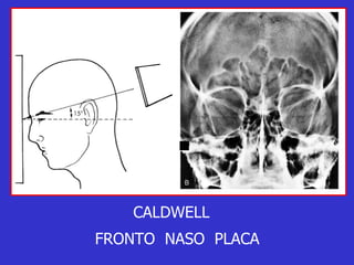 CALDWELL FRONTO  NASO  PLACA 
