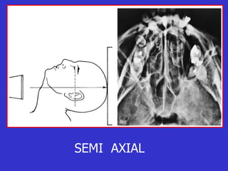 SEMI  AXIAL 