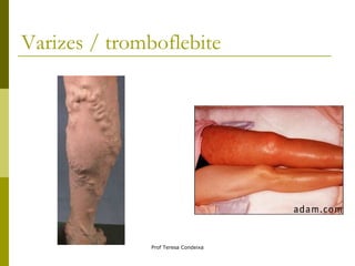 Varizes / tromboflebite 