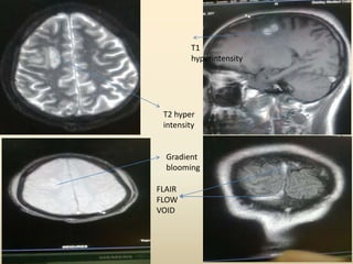 T2 hyper
intensity
Gradient
blooming
T1
hyperintensity
FLAIR
FLOW
VOID
 