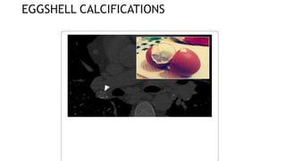 EGGSHELL CALCIFICATIONS
 