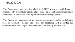 HALO SIGN
•The “halo sign” may be highlighted in MDCT when a solid lesion is
surrounded by a peripheral ground glass area. The ground glass attenuation, in
most cases, is considered to be a perilesional hemorrhagic process.
•This finding was associated with a broader spectrum of possible pathologies,
such as neoplastic lesions and other non-neoplastic and non-infectious
conditions (vasculitis, organizing pneumonia, pulmonary endometriosis)
 
