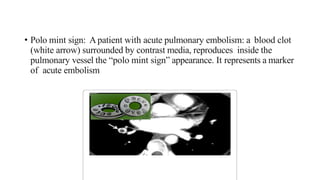 • Polo mint sign: Apatient with acute pulmonary embolism: a blood clot
(white arrow) surrounded by contrast media, reproduces inside the
pulmonary vessel the “polo mint sign” appearance. It represents a marker
of acute embolism
 