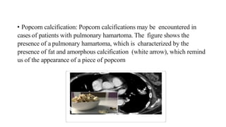 • Popcorn calcification: Popcorn calcifications may be encountered in
cases of patients with pulmonary hamartoma. The figure shows the
presence of a pulmonary hamartoma, which is characterized by the
presence of fat and amorphous calcification (white arrow), which remind
us of the appearance of a piece of popcorn
 
