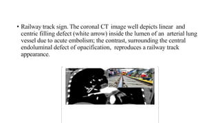 • Railway track sign. The coronal CT image well depicts linear and
centric filling defect (white arrow) inside the lumen of an arterial lung
vessel due to acute embolism; the contrast, surrounding the central
endoluminal defect of opacification, reproduces a railway track
appearance.
 