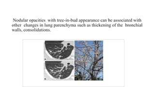Nodular opacities with tree-in-bud appearance can be associated with
other changes in lung parenchyma such as thickening of the bronchial
walls, consolidations.
 