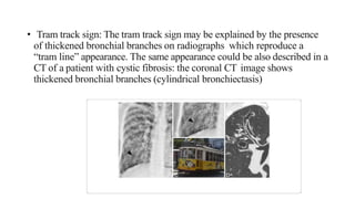 • Tram track sign: The tram track sign may be explained by the presence
of thickened bronchial branches on radiographs which reproduce a
“tram line” appearance. The same appearance could be also described in a
CT of a patient with cystic fibrosis: the coronal CT image shows
thickened bronchial branches (cylindrical bronchiectasis)
 
