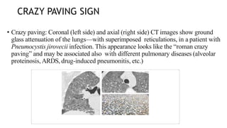 CRAZY PAVING SIGN
• Crazy paving: Coronal (left side) and axial (right side) CT images show ground
glass attenuation of the lungs—with superimposed reticulations, in a patient with
Pneumocystis jirovecii infection. This appearance looks like the “roman crazy
paving” and may be associated also with different pulmonary diseases (alveolar
proteinosis, ARDS, drug-induced pneumonitis, etc.)
 