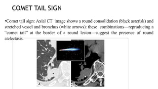 COMET TAIL SIGN
•Comet tail sign: Axial CT image shows a round consolidation (black asterisk) and
stretched vessel and bronchus (white arrows): these combinations—reproducing a
“comet tail” at the border of a round lesion—suggest the presence of round
atelectasis.
 