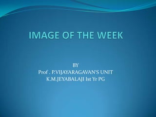 IMAGE OF THE WEEK BY  Prof . P.VIJAYARAGAVAN‘S UNIT          K.M.JEYABALAJI Ist Yr PG     