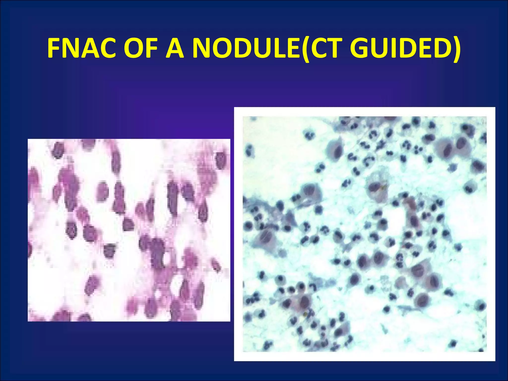 FNAC OF A NODULE(CT GUIDED) 