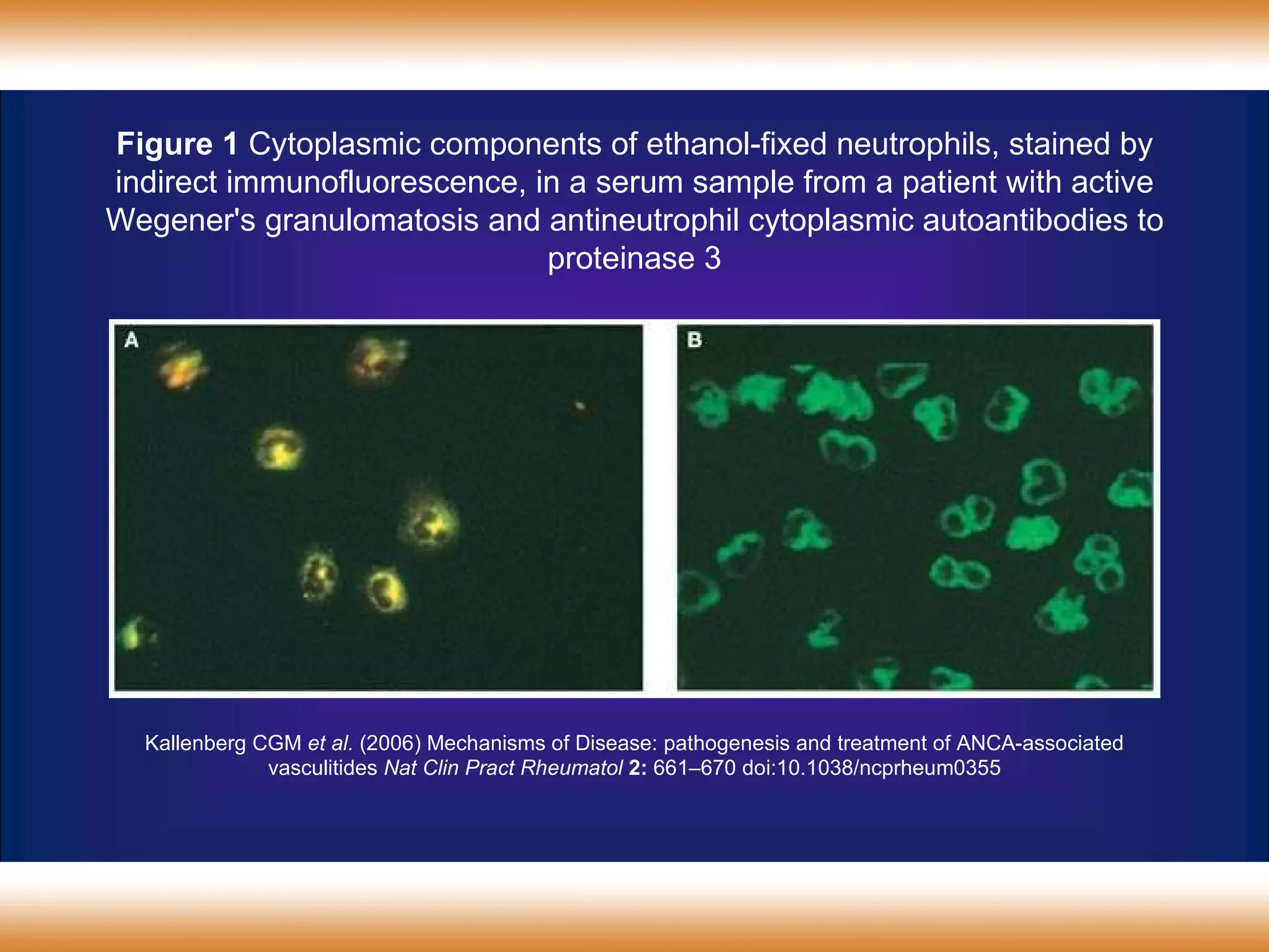 Kallenberg CGM  et al.  (2006) Mechanisms of Disease: pathogenesis and treatment of ANCA-associated vasculitides  Nat Clin Pract  Rheumatol   2:   661 – 670  doi:10.1038/ ncprheum0355 Figure 1  Cytoplasmic components of ethanol-fixed neutrophils, stained by indirect immunofluorescence, in a serum sample from a patient with active Wegener's granulomatosis and antineutrophil cytoplasmic autoantibodies to proteinase 3 