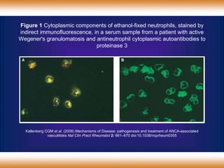 Kallenberg CGM  et al.  (2006) Mechanisms of Disease: pathogenesis and treatment of ANCA-associated vasculitides  Nat Clin Pract  Rheumatol   2:   661 – 670  doi:10.1038/ ncprheum0355 Figure 1  Cytoplasmic components of ethanol-fixed neutrophils, stained by indirect immunofluorescence, in a serum sample from a patient with active Wegener's granulomatosis and antineutrophil cytoplasmic autoantibodies to proteinase 3 