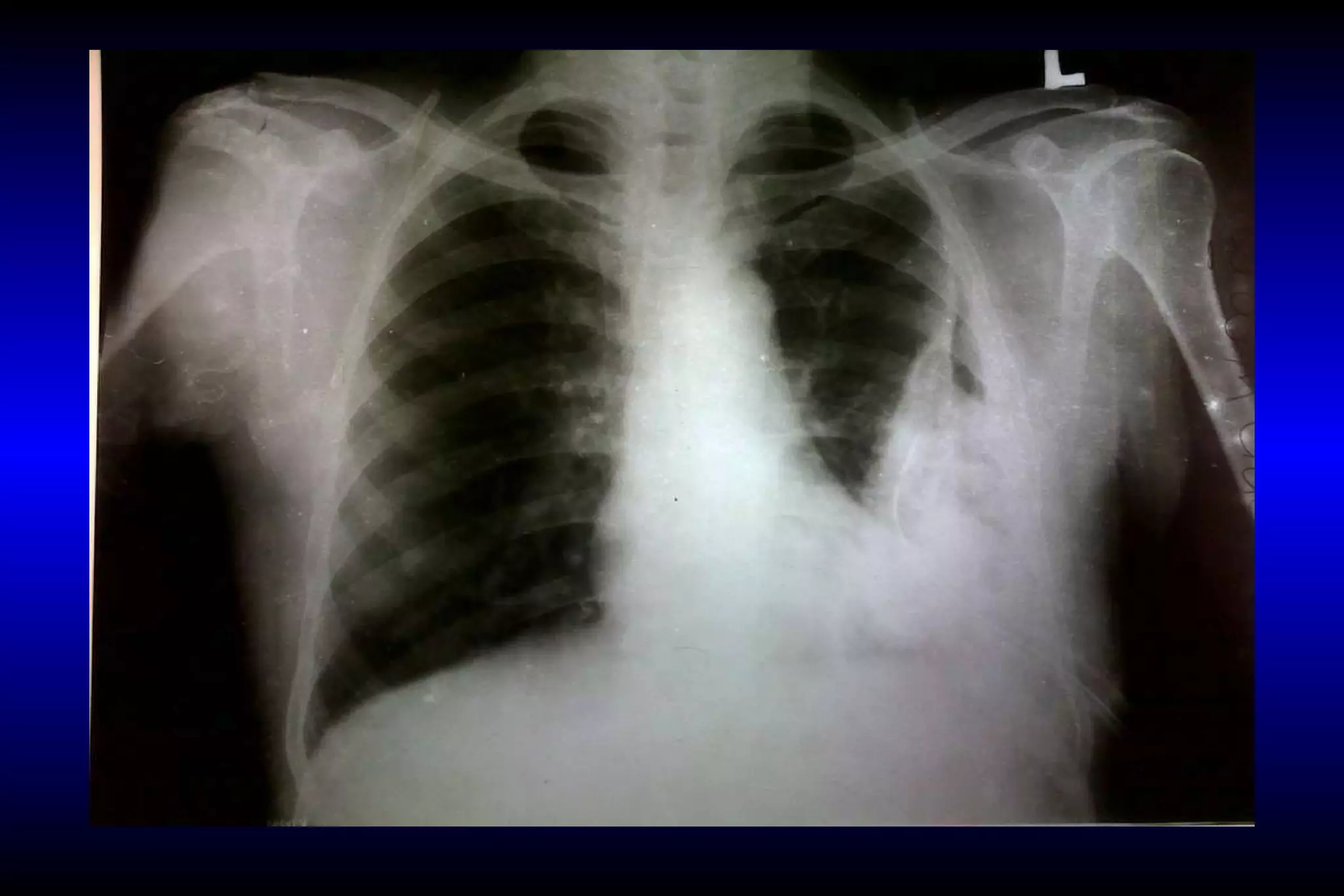 CXR: Loculated Empyema | PPT