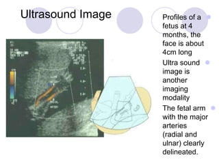 Ultrasound Image Profiles of a
fetus at 4
months, the
face is about
4cm long
Ultra sound
image is
another
imaging
modality
The fetal arm
with the major
arteries
(radial and
ulnar) clearly
delineated.
 
