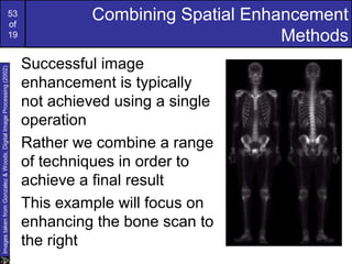 53
of
19
Combining Spatial Enhancement
Methods
Successful image
enhancement is typically
not achieved using a single
operation
Rather we combine a range
of techniques in order to
achieve a final result
This example will focus on
enhancing the bone scan to
the right
ImagestakenfromGonzalez&Woods,DigitalImageProcessing(2002)
 