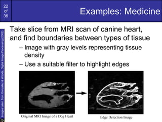22
of
36
Examples: Medicine
Take slice from MRI scan of canine heart,
and find boundaries between types of tissue
– Image with gray levels representing tissue
density
– Use a suitable filter to highlight edges
Original MRI Image of a Dog Heart Edge Detection Image
Images
taken
from
Gonzalez
&
Woods,
Digital
Image
Processing
(2002)
 