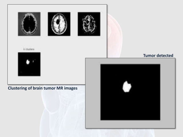 BRAIN TUMOR MRI IMAGE SEGMENTATION AND DETECTION IN IMAGE PROCESSING ...