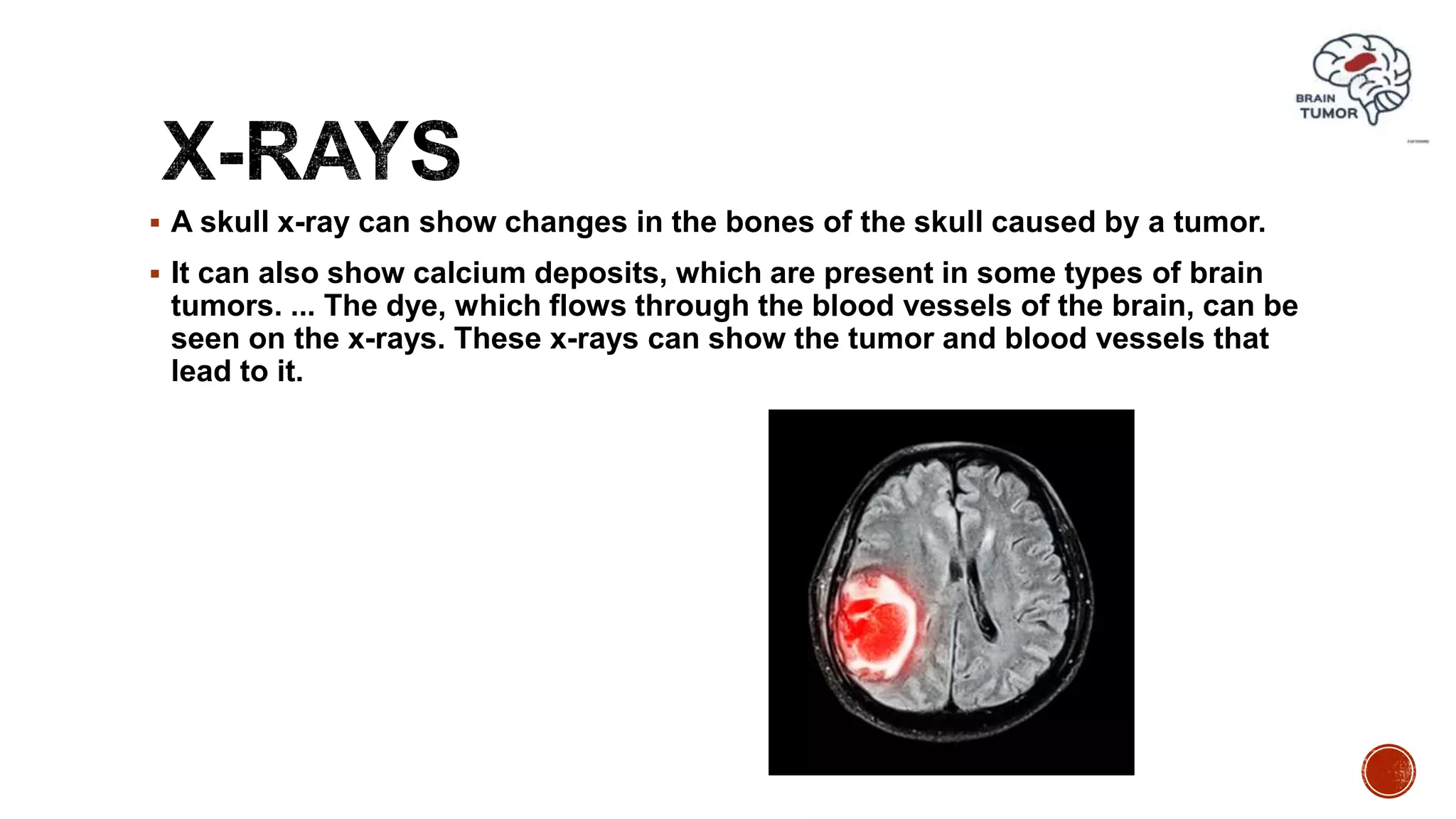  A skull x-ray can show changes in the bones of the skull caused by a tumor.
 It can also show calcium deposits, which are present in some types of brain
tumors. ... The dye, which flows through the blood vessels of the brain, can be
seen on the x-rays. These x-rays can show the tumor and blood vessels that
lead to it.
 