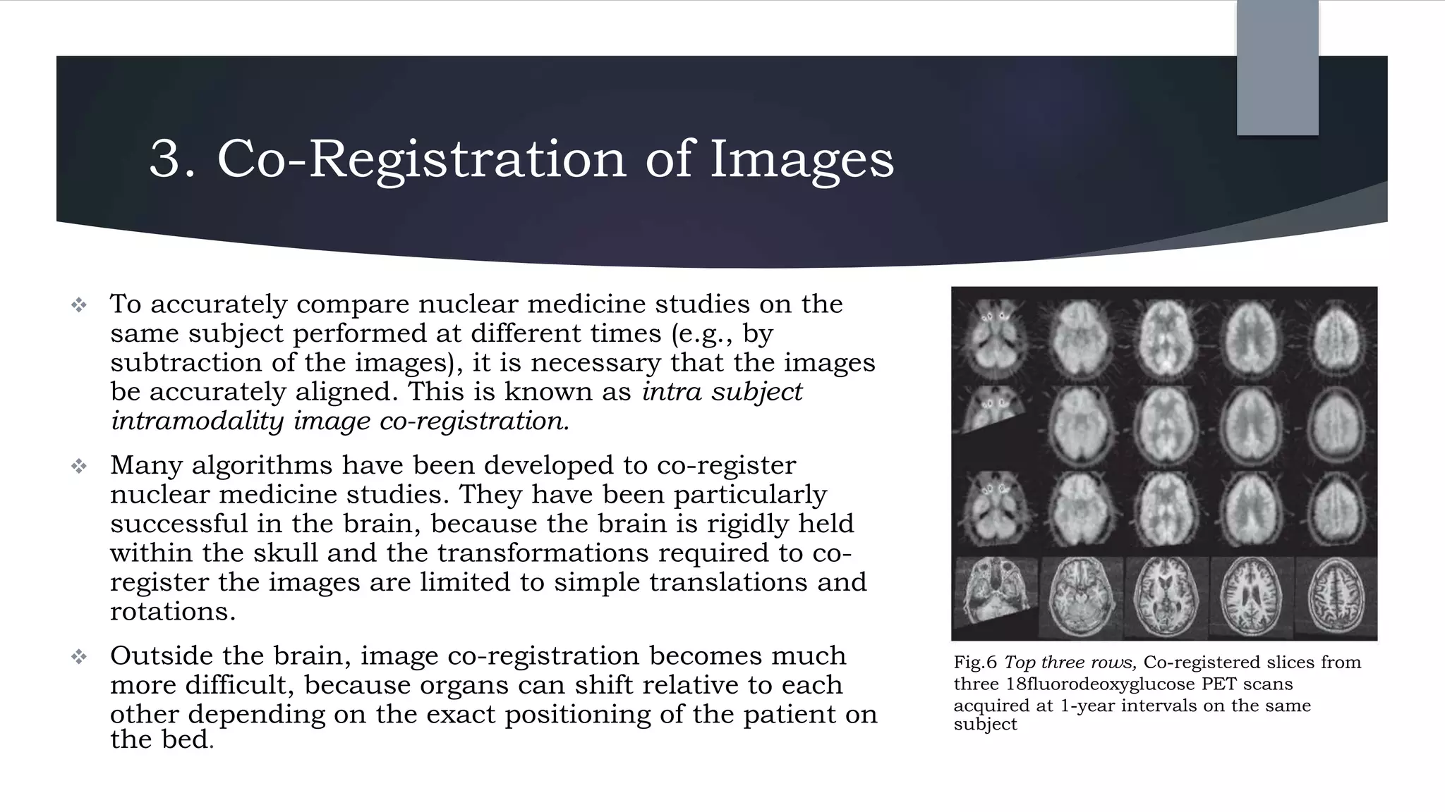 3. Co-Registration of Images
 To accurately compare nuclear medicine studies on the
same subject performed at different times (e.g., by
subtraction of the images), it is necessary that the images
be accurately aligned. This is known as intra subject
intramodality image co-registration.
 Many algorithms have been developed to co-register
nuclear medicine studies. They have been particularly
successful in the brain, because the brain is rigidly held
within the skull and the transformations required to co-
register the images are limited to simple translations and
rotations.
 Outside the brain, image co-registration becomes much
more difficult, because organs can shift relative to each
other depending on the exact positioning of the patient on
the bed.
Fig.6 Top three rows, Co-registered slices from
three 18fluorodeoxyglucose PET scans
acquired at 1-year intervals on the same
subject
 