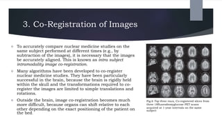 3. Co-Registration of Images
 To accurately compare nuclear medicine studies on the
same subject performed at different times (e.g., by
subtraction of the images), it is necessary that the images
be accurately aligned. This is known as intra subject
intramodality image co-registration.
 Many algorithms have been developed to co-register
nuclear medicine studies. They have been particularly
successful in the brain, because the brain is rigidly held
within the skull and the transformations required to co-
register the images are limited to simple translations and
rotations.
 Outside the brain, image co-registration becomes much
more difficult, because organs can shift relative to each
other depending on the exact positioning of the patient on
the bed.
Fig.6 Top three rows, Co-registered slices from
three 18fluorodeoxyglucose PET scans
acquired at 1-year intervals on the same
subject
 