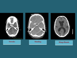 Streaks Shading Rings/Bands
 