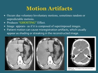  Occurs due voluntary/involuntary motions, sometimes random or
unpredictable motions.
 Produces “GHOSTING” Effect.
 Image appears– as if it is composed of superimposed images.
 Patient motion can cause misregistration artifacts, which usually
appear as shading or streaking in the reconstructed image.
 