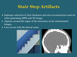  Improper selection of slice thickness and slice reconstruction interval
when generating MPR and 3D image.
 Appears around the edges of the structures in the reformmated
images.
 Less severe with the helical scans .
 