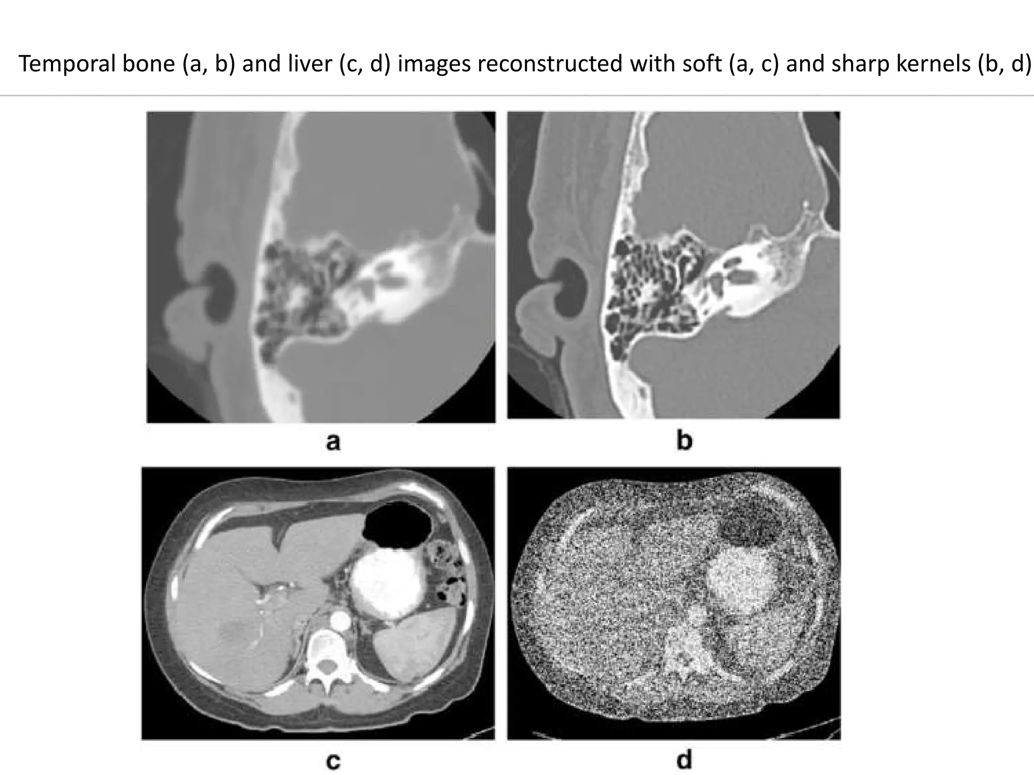 Temporal bone (a, b) and liver (c, d) images reconstructed with soft (a, c) and sharp kernels (b, d)
 