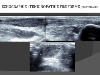ECHOGRAPHIE : TENDINOPATHIE FUSIFORME (CORPORÉALE)
 