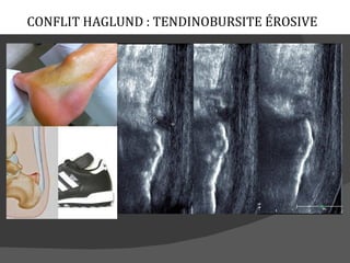 CONFLIT HAGLUND : TENDINOBURSITE ÉROSIVE
 