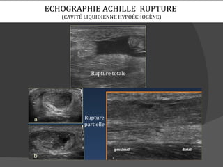 ECHOGRAPHIE ACHILLE RUPTURE
   (CAVITÉ LIQUIDIENNE HYPOÉCHOGÈNE)




             Rupture totale




          Rupture
          partielle
 