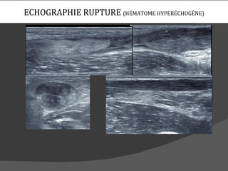 ECHOGRAPHIE RUPTURE (HÉMATOME HYPERÉCHOGÈNE)
 