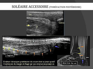 SOLÉAIRE ACCESSOIRE (TUMÉFACTION POSTÉRIEURE)
 