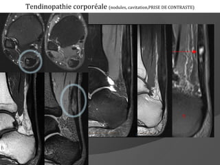 Tendinopathie corporéale (nodules, cavitation,PRISE DE CONTRASTE)
 