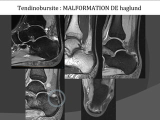 Tendinobursite : MALFORMATION DE haglund
 
