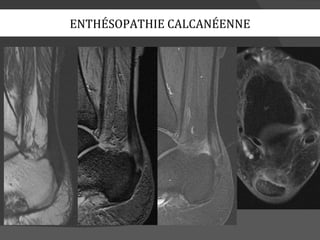 ENTHÉSOPATHIE CALCANÉENNE
 