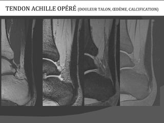 TENDON ACHILLE OPÉRÉ (DOULEUR TALON, ŒDÈME, CALCIFICATION)
 
