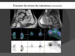 Fracture de stress du calcaneus (TALALGIES)
 