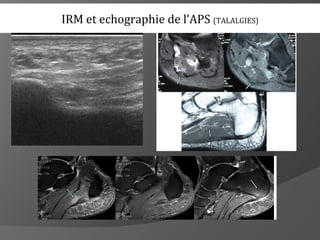 IRM et echographie de l’APS (TALALGIES)
 
