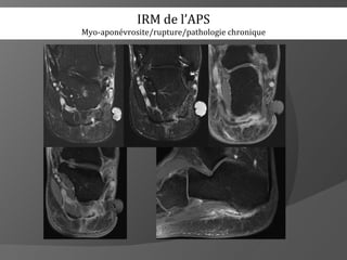 IRM de l’APS
Myo-aponévrosite/rupture/pathologie chronique
 