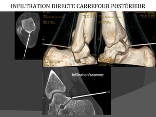 INFILTRATION DIRECTE CARREFOUR POSTÉRIEUR




                  Infiltration/scanner
 