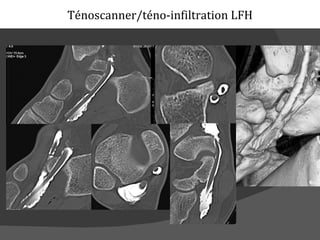 Ténoscanner/téno-infiltration LFH
 