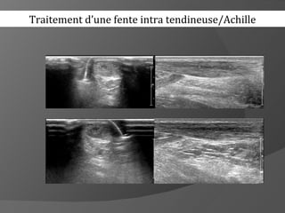 Traitement d’une fente intra tendineuse/Achille
 