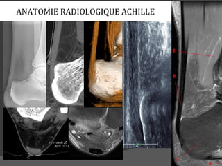 ANATOMIE RADIOLOGIQUE ACHILLE
 