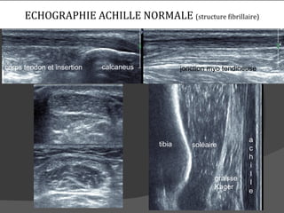 ECHOGRAPHIE ACHILLE NORMALE (structure fibrillaire)



corps tendon et insertion   calcaneus           jonction myo tendineuse




                                                                    a
                                        tibia      soléaire         c
                                                                    h
                                                                    i
                                                                    l
                                                          graisse
                                                                    l
                                                          Kager
                                                                    e
 