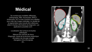 Médical
De nombreuses modalités différentes
(radiographie, IRM, microscopie, SPECT,
endoscopie, OCT et bien d'autres) sont utilisées
pour créer des images médicales. Le résultat de
la segmentation peut ensuite être utilisé pour
obtenir d'autres informations de diagnostic. Les
applications possibles sont :
-Localisation des tumeurs et d'autres
pathologies
-Mesurer les volumes de tissus
-Diagnostic, étude de la structure anatomique
-Simulation de chirurgie virtuelle
-Navigation intra-chirurgicale
etc..
30
 